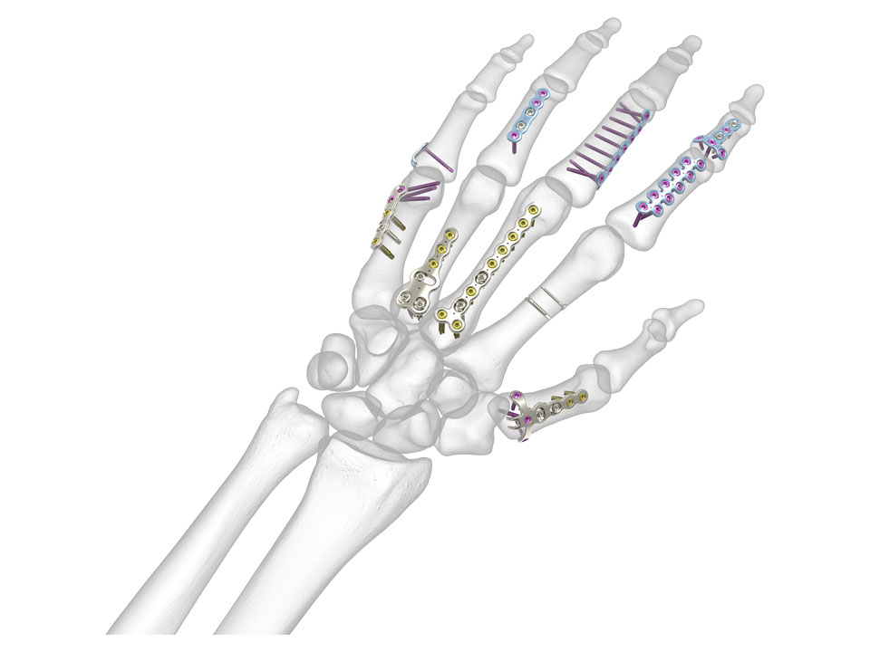 Sistema de fractura de mano